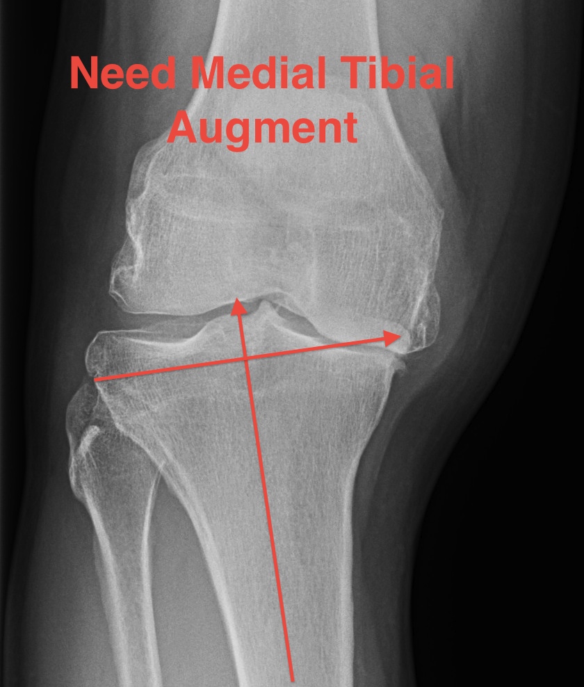 TKR Severe Varus Requiring Medial Augment